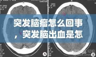 突发脑瘤怎么回事,突发脑出血是怎么回事